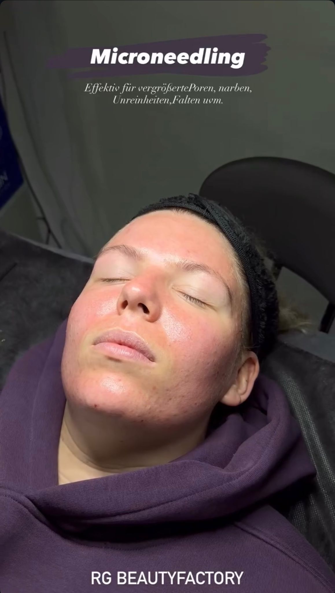 Microneedling Behandlung