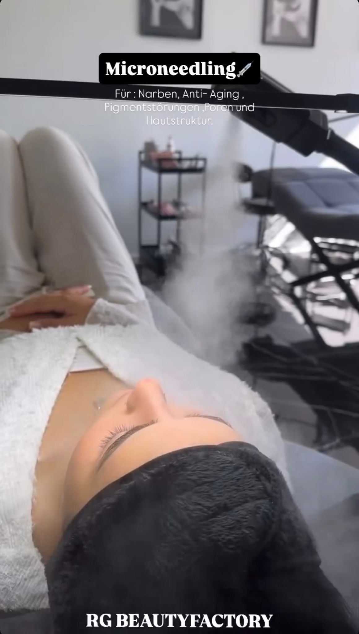 Microneedling Behandlung